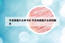牛皮癬是什么樣子的 牛皮有癬是什么樣的圖片