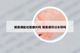 銀屑病能吃新癀片嗎 銀屑病可以補(bǔ)鋅嗎