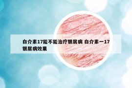 白介素17能不能治療銀屑病 白介素一17銀屑病效果