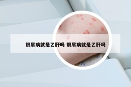 銀屑病就是乙肝嗎 銀屑病就是乙肝嗎