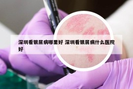 深圳看銀屑病哪里好 深圳看銀屑病什么醫(yī)院好