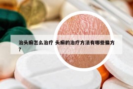 治頭癬怎么治療 頭癬的治療方法有哪些偏方?