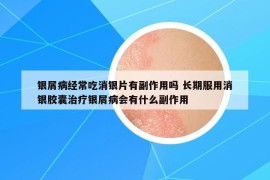 銀屑病經(jīng)常吃消銀片有副作用嗎 長期服用消銀膠囊治療銀屑病會有什么副作用