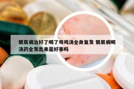 銀屑病治好了喝了母雞湯全身復(fù)發(fā) 銀屑病喝湯藥全發(fā)出來是好事嗎