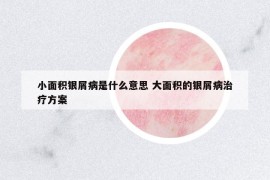 小面積銀屑病是什么意思 大面積的銀屑病治療方案