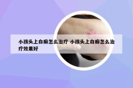 小孩頭上白癬怎么治療 小孩頭上白癬怎么治療效果好