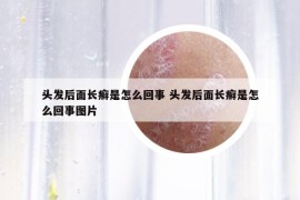 頭發(fā)后面長癬是怎么回事 頭發(fā)后面長癬是怎么回事圖片