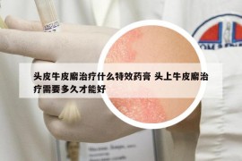 頭皮牛皮廨治療什么特效藥膏 頭上牛皮廨治療需要多久才能好