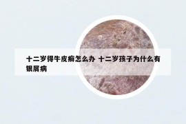 十二歲得牛皮癬怎么辦 十二歲孩子為什么有銀屑病