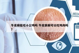 牛皮癬能吃小公雞嗎 牛皮膚癬可以吃雞肉嗎?