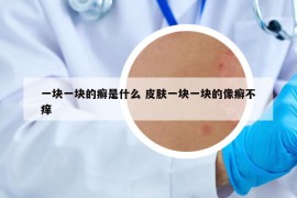 一塊一塊的癬是什么 皮膚一塊一塊的像癬不癢