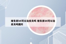 維生素b6可以治皮炎嗎 維生素b6可以治皮炎嗎圖片