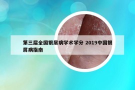 第三屆全國銀屑病學(xué)術(shù)學(xué)分 2019中國銀屑病指南
