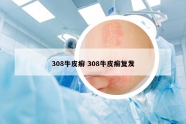 308牛皮癬 308牛皮癬復發(fā)