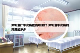 深圳治療牛皮癬醫(yī)院哪里好 深圳治牛皮癬的費(fèi)用是多少