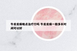 牛皮皮癬晚點治療行嗎 牛皮皮癬一般多長時間可以好