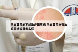他克莫司能不能治療銀屑病 他克莫司軟膏治銀屑病效果怎么樣