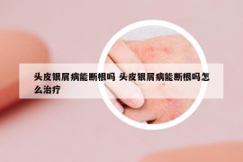 頭皮銀屑病能斷根嗎 頭皮銀屑病能斷根嗎怎么治療