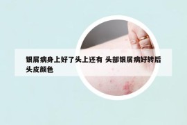 銀屑病身上好了頭上還有 頭部銀屑病好轉(zhuǎn)后頭皮顏色