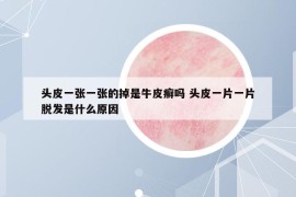 頭皮一張一張的掉是牛皮癬嗎 頭皮一片一片脫發(fā)是什么原因