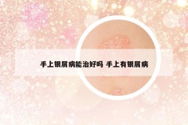 手上銀屑病能治好嗎 手上有銀屑病