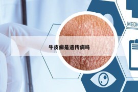 牛皮癬是遺傳病嗎