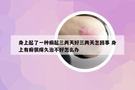 身上起了一種癬起三兩天好三兩天怎回事 身上有癬很癢久治不好怎么辦