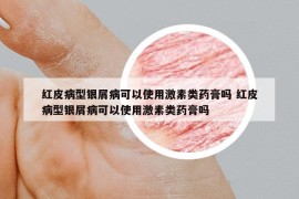 紅皮病型銀屑病可以使用激素類藥膏嗎 紅皮病型銀屑病可以使用激素類藥膏嗎