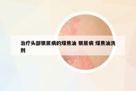 治療頭部銀屑病的煤焦油 銀屑病 煤焦油洗劑