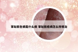掌趾膿包病是什么病 掌趾膿皰病怎么樣根治