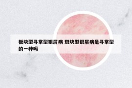 板塊型尋常型銀屑病 斑塊型銀屑病是尋常型的一種嗎