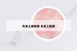 頭皮上面有癬 頭皮上起癬