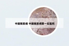 中國銀屑病 中國銀屑病第一名醫(yī)院