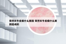 突然長牛皮癬什么原因 突然長牛皮癬什么原因造成的