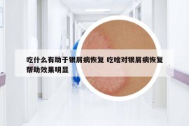 吃什么有助于銀屑病恢復(fù) 吃啥對(duì)銀屑病恢復(fù)幫助效果明顯