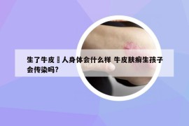 生了牛皮癬人身體會什么樣 牛皮膚癬生孩子會傳染嗎?