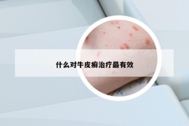 什么對(duì)牛皮癬治療最有效