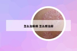 怎么治癬病 怎么根治蘚