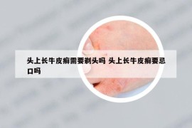 頭上長牛皮癬需要剃頭嗎 頭上長牛皮癬要忌口嗎