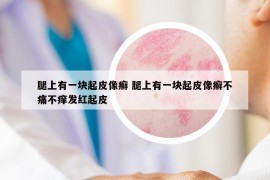 腿上有一塊起皮像癬 腿上有一塊起皮像癬不痛不癢發(fā)紅起皮