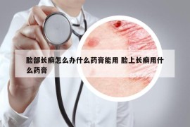 臉部長癬怎么辦什么藥膏能用 臉上長癬用什么藥膏