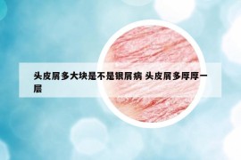頭皮屑多大塊是不是銀屑病 頭皮屑多厚厚一層