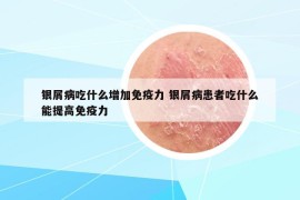 銀屑病吃什么增加免疫力 銀屑病患者吃什么能提高免疫力