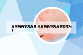 銀屑病關(guān)節(jié)炎海參 銀屑病關(guān)節(jié)炎海參能吃嗎?