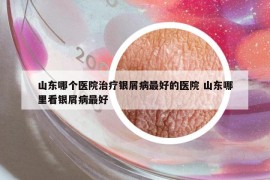 山東哪個(gè)醫(yī)院治療銀屑病最好的醫(yī)院 山東哪里看銀屑病最好