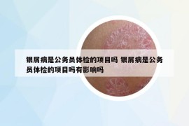 銀屑病是公務員體檢的項目嗎 銀屑病是公務員體檢的項目嗎有影響嗎