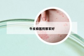 牛皮癬醫(yī)院那家好