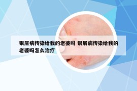 銀屑病傳染給我的老婆嗎 銀屑病傳染給我的老婆嗎怎么治療