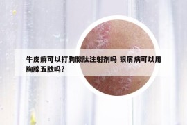 牛皮癬可以打胸腺肽注射劑嗎 銀屑病可以用胸腺五肽嗎?