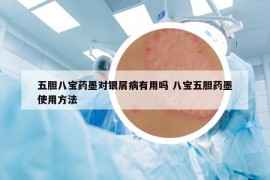 五膽八寶藥墨對銀屑病有用嗎 八寶五膽藥墨使用方法